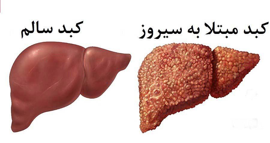 بیماری سیروز کبدی چیست و چه درمانی دارد؟