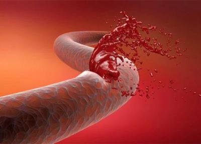 انواع خونریزی و روش متوقف کردن آن ها؛ مرز باریک مرگ و زندگی