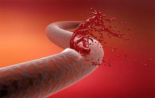 انواع خونریزی و روش متوقف کردن آن ها؛ مرز باریک مرگ و زندگی
