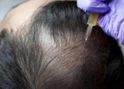 پیشگیری از ریزش مو ناشی از استرس